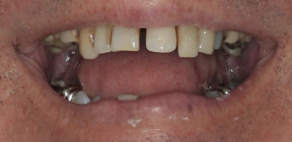 Before-dente