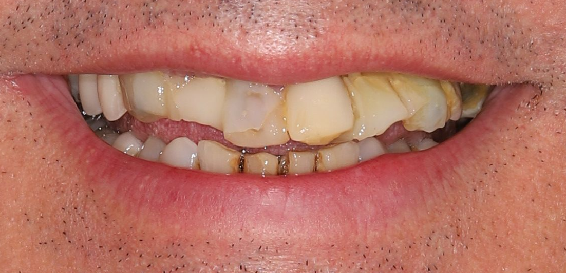 Before-dentes