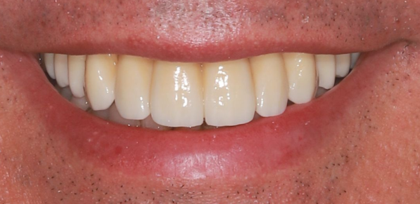 After-dentes